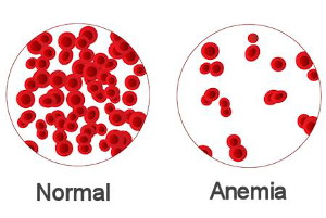 Graphic of many normal red blood cells vs few red blood cells in cases of Anemia