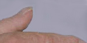 clubbed fingernails b12