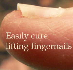 Easily cure lifting fingernails - condition known as Onycholysis