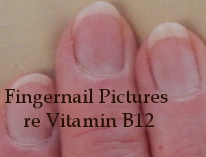 Vitamin B12 and Fingernails Pictures