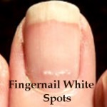 Fingernail White Spots