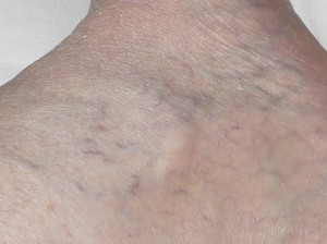 Serrapeptase Vein Photos