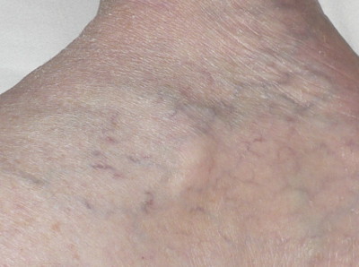 Serrapeptase working on veins - 2 weeks later