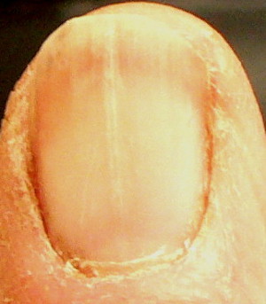 thick whitish ridge on fingernail