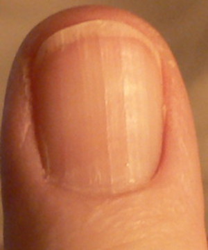 photo of thumb nail clearly shows ridges