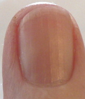 Photo - B12 shot and vitamin C make a visible difference in fingernail