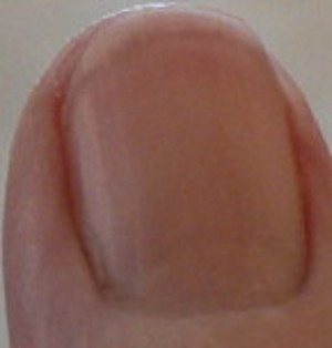 pitting not shown clearly by photo - looks a lot like "water spots" on my middle fingernail