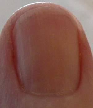 redness under fingernails forming streaks