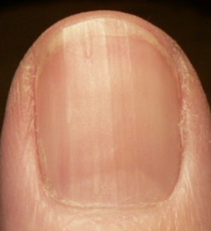 Thumbnail with moon despite ridges showing low Vitamin B12 levels