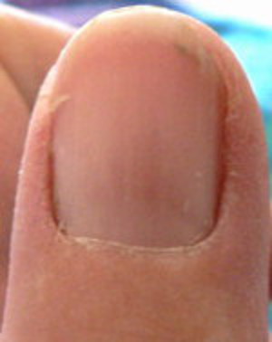 reddish area under fingernail forming into lines