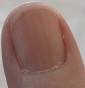 Redness under fingernail