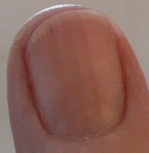 fingernail moon shows improvement from B12 shots and vitamin C