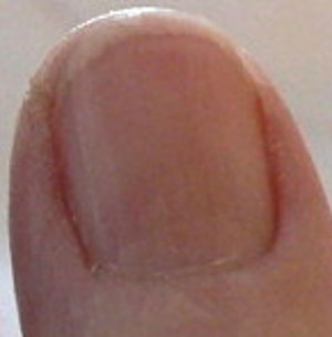 Photo - Fingernail before vitamin C or B12 - redness is darker - moon no longer clear