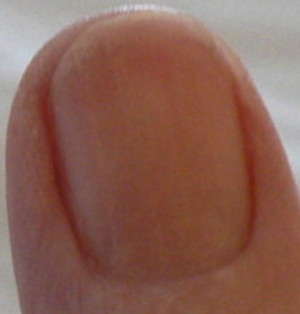 photo showing overnight toothache corresponds with redness obscuring fingernail moon