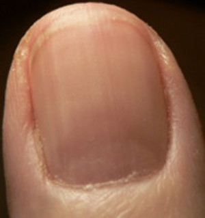 Thick fingernail ridge has grown out. Reddish area indicates infection