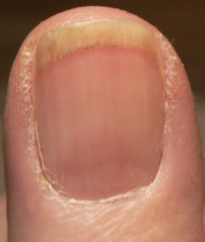 photo of reddish line to the right of center and along top of finger where it attaches to nail