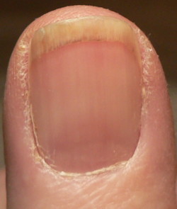 Fingernails and Redness | Health Boundaries