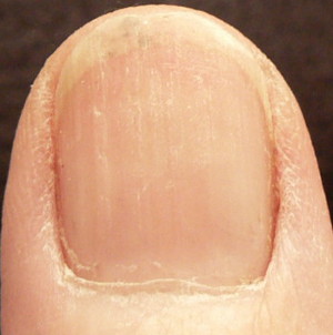 photo - red/taupe line no longer goes all the way to the top of the nail bed with vitamin C use