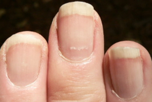 White spots on fingernail 