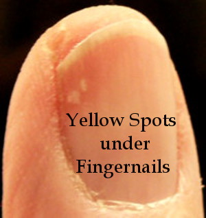Yellow Spots under Fingernails