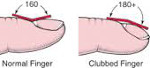 graphic Normal vs Clubbed fingernail