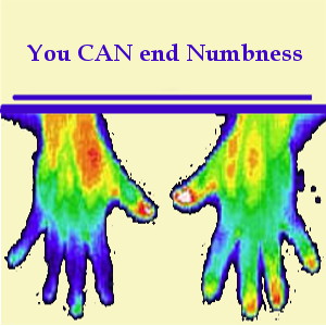 Numbness Ended - Digital Thermography shows numbness in the hand on the left