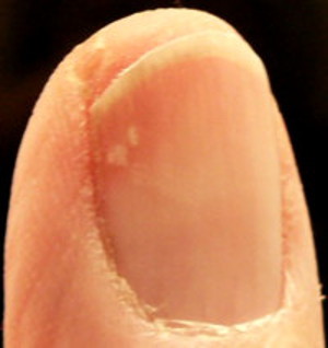 Yellow spots under fingernail