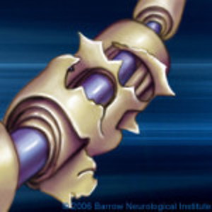 Illustration of tattered myelin sheath on a nerve