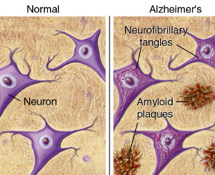 plaques_and_tangles_border neuron - Normal brain vs brain with amyloid plaque buildups