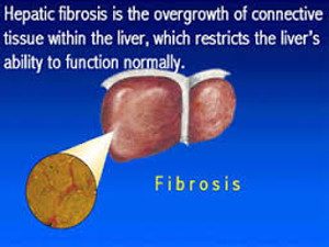 Fibrosis - Hepatic fibrosis is the overgrowth of connective tissue within the liver, which restricts the liver's ability to function normally.
