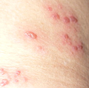 Fever blisters appeared after initial burning pain