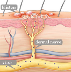 Drawing of shingles fever blisters, dermal nerve and virus