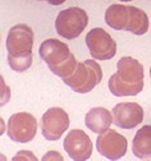 blood cells in an over acidic body
