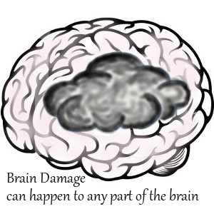 Brain Damage and Low B12 - Brain damage can happen to any part of the brain