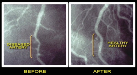 Diseased artery from a meat protein diet vs Healthy artery from plant protein diet