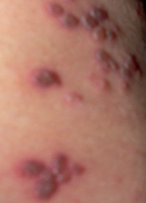 Photo - Shingles fever blisters on the 4th day