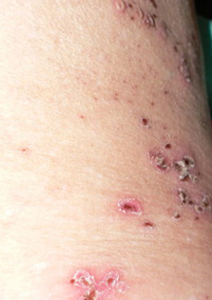 Photo - Shingles Fever Blisters about 10 days later