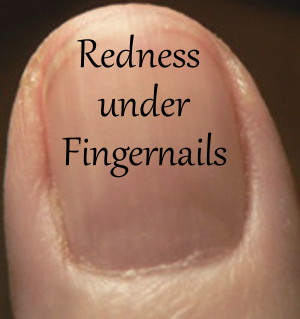 Redness under Fingernails