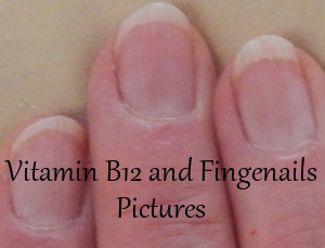 Vitamin B12 and Fingernails Pictures