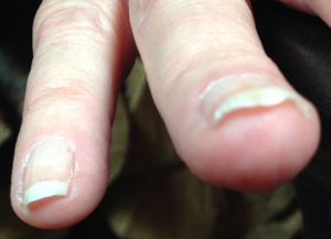 Bending Fingernail viewed from the front