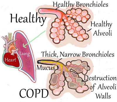 COPD Graphic