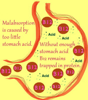 Vitamin B12 Malabsorption