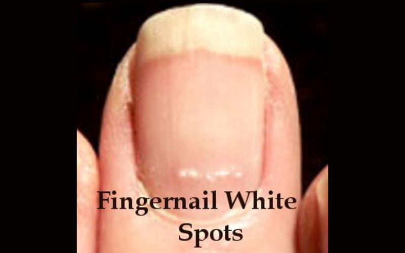 Fingernail White Spots · Health Boundaries