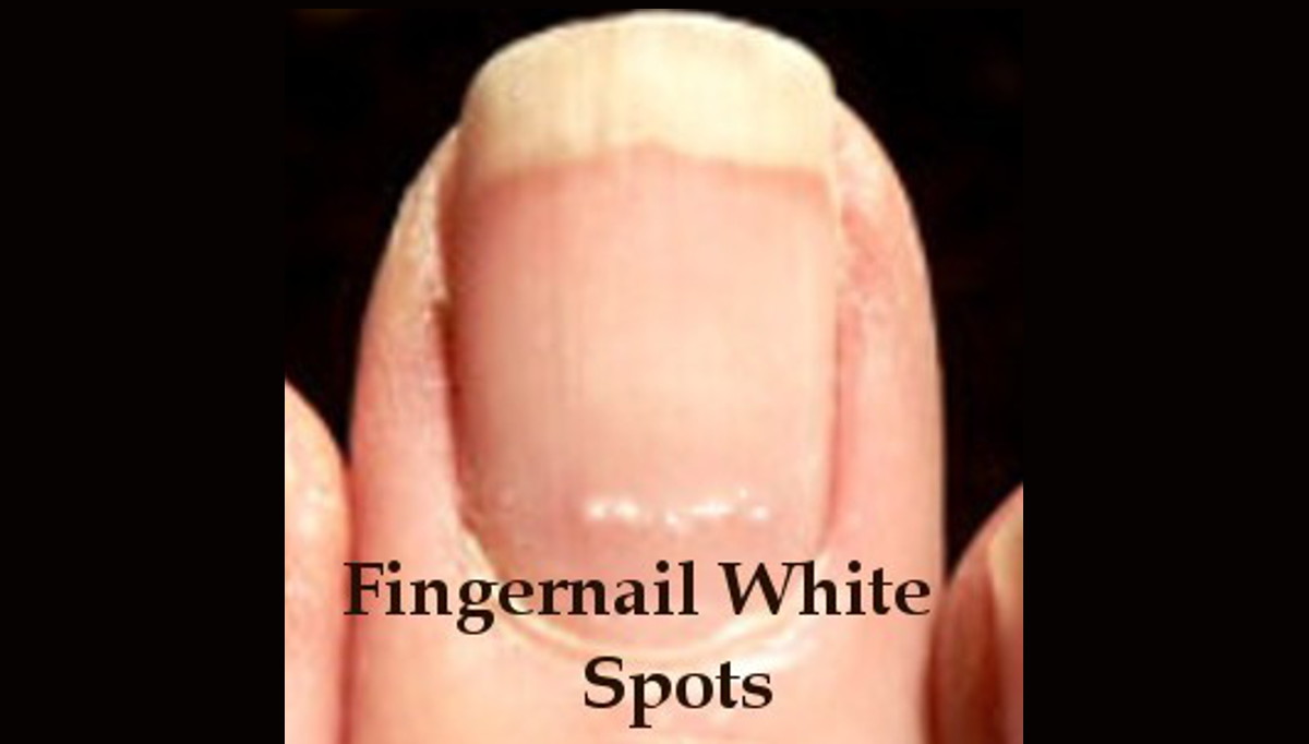 Fingernail White Spots