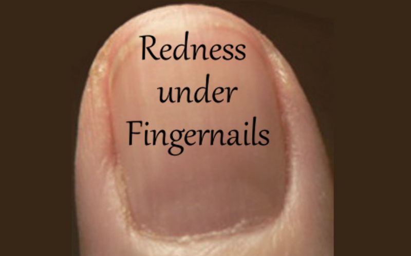 Redness Under Fingernails Health Boundaries