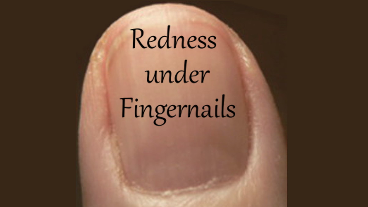 What Causes Redness Under Your Fingernails