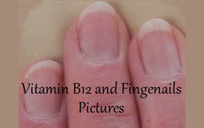 Vitamin B12 and Fingernails Pictures · Health Boundaries