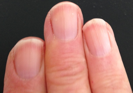 Redness under Fingernails